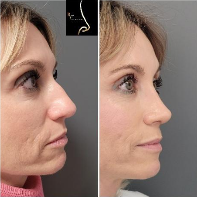 Antes y después de una rinoplastia en Sevilla